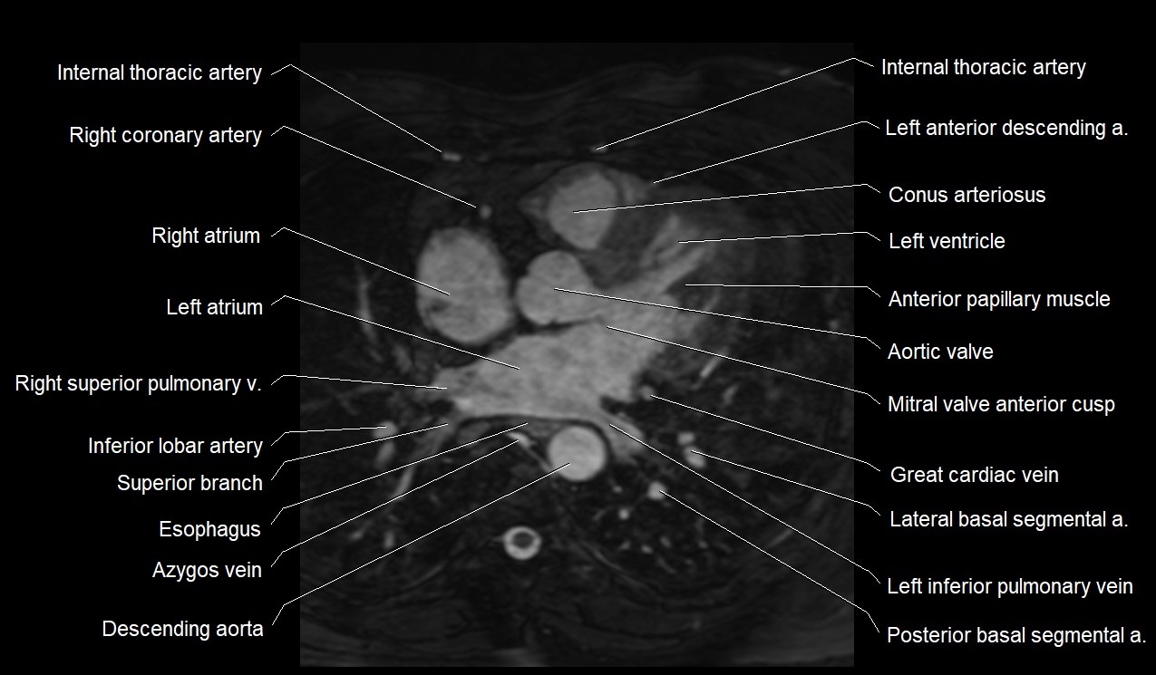 MRI heart coronary arteries and coronary veins anatomy axial image 21.jpg